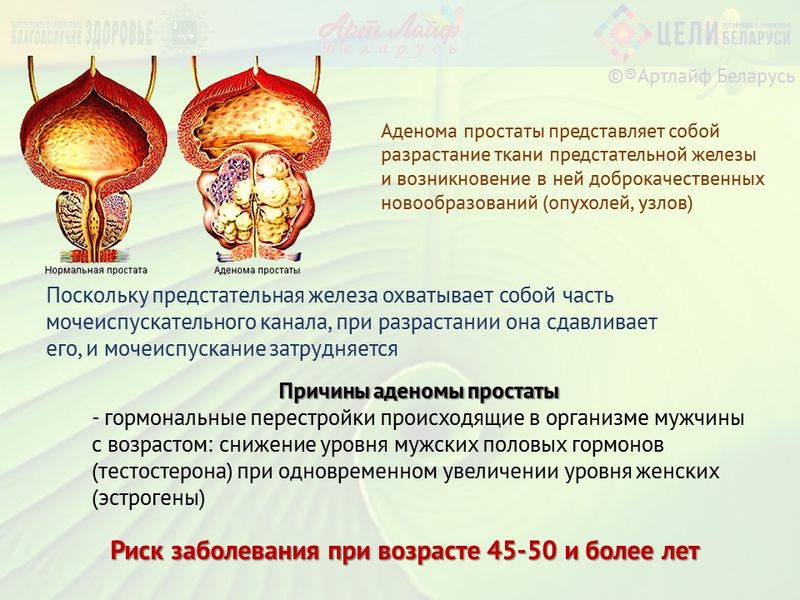Можно Ли Заниматься Сексом При Аденоме Можно Ли Заниматься Сексом При Аденоме