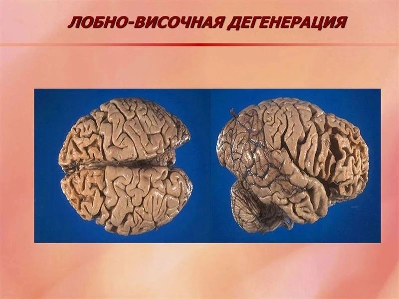 Лобно-височная деменция: причины и механизмы