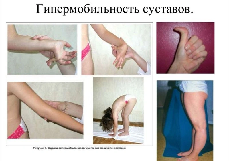 Дисплазия соединительной ткани