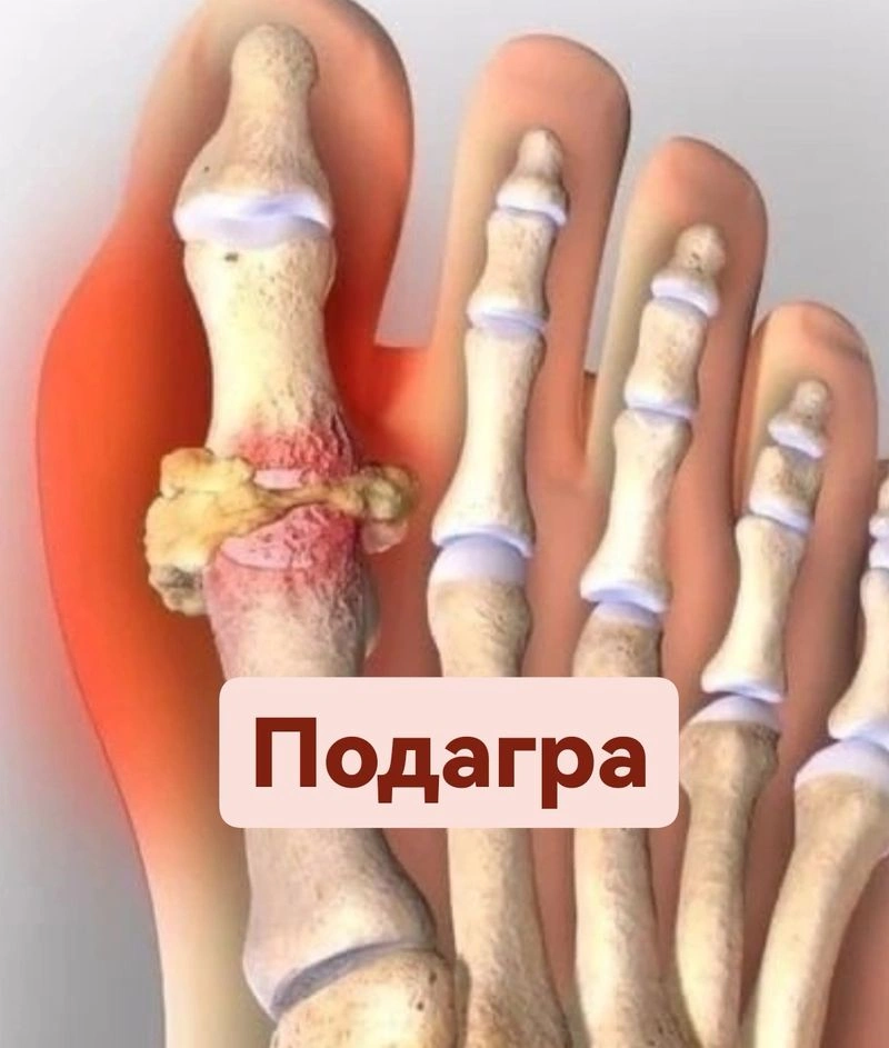 Подагра