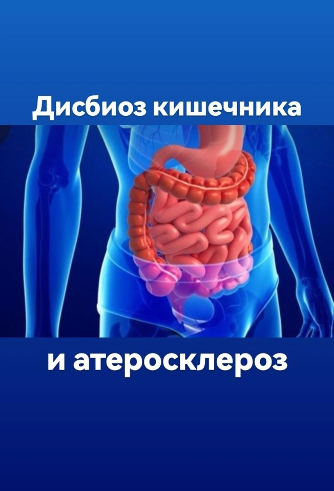 Дисбиоз кишечника и атеросклероз. Что синтезирует микробиота. Как себе помочь?