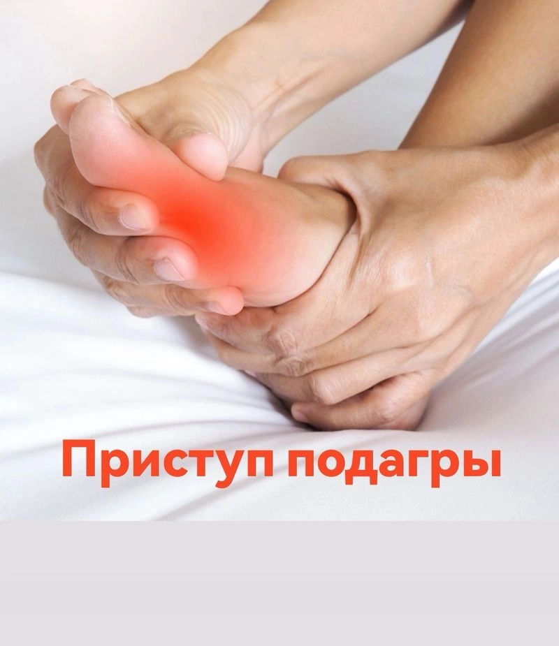Приступ подагры у пациента с высоким сосудистым риском
