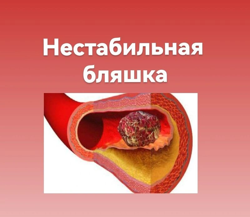 Нестабильная бляшка