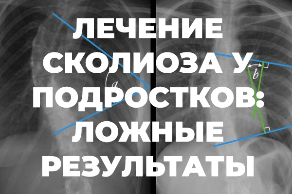 Статья: Лечение сколиоза у подростков — ложные результаты.