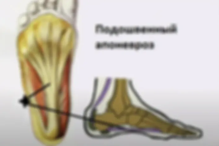 Судороги в апоневрозе стопы и пальцах ног. Решение на примере клиентки