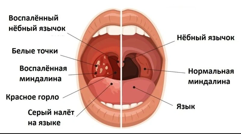 Альтернативное лечение хронического тонзиллита