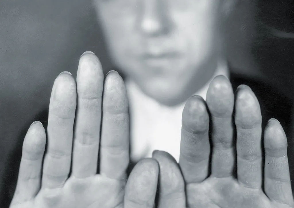 Пальцы Карписа с деформированными подушечками