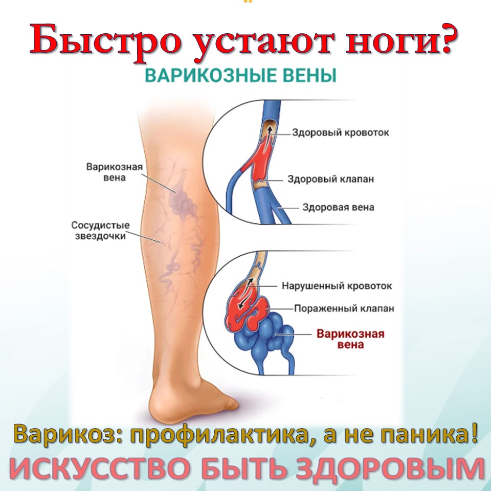 Варикоз – это не приговор,
вынесенный исключительно людям "бальзаковского возраста". Миф о том,
что варикозное расширение вен – исключительно удел пожилых, давно пора
развеять. Первые тревожные звоночки могут прозвучать уже в молодости, и игнорировать
их – опасная игра.