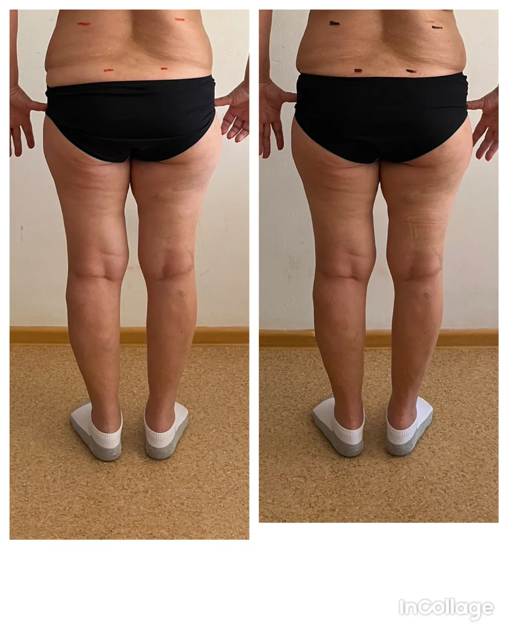 Зажим седалищного нерва. Убрали боль на 100% за один сеанс